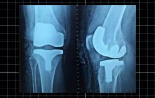 Person with knee replacement surgery